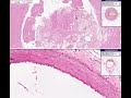 Histopathology Coronary artery--Atherosclerosis- recanalizat