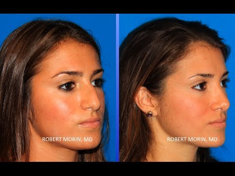 Rhinoplasty NYC Before and After Plastic Surgeon <b>Robert Morin</b> MD - 0