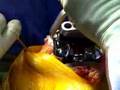 Total Knee Replacement Surgery