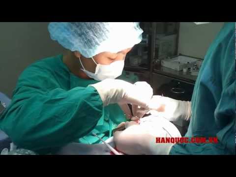 Nâng Mũi S Line Thẩm Mỹ Hàn Quốc