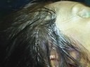 In the Operating Room - Deep Temporalis Fascia for Rhinoplasty