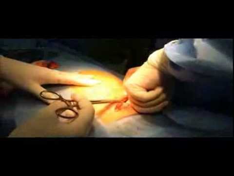 how to locate cbd on ultrasound