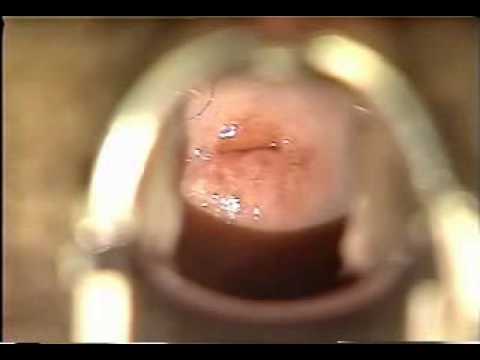 gyno exam