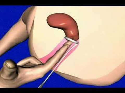 pap smear video pap smear video