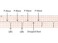 ECG Course 2