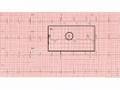 ECG Course 2