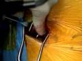 Avoiding Fusion in Early Onset Scoliosis: Growing Rods/VEPTR
