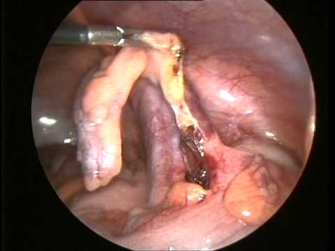 how to perform appendix surgery
