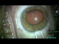 lente intraocular bifocal cirugia de catarata