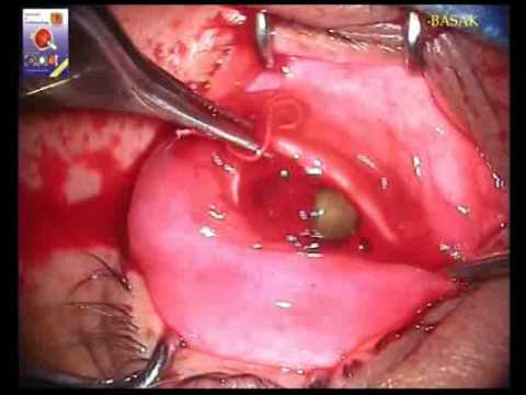 evisceration - 