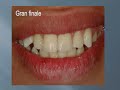 Esthetic Class IV`s