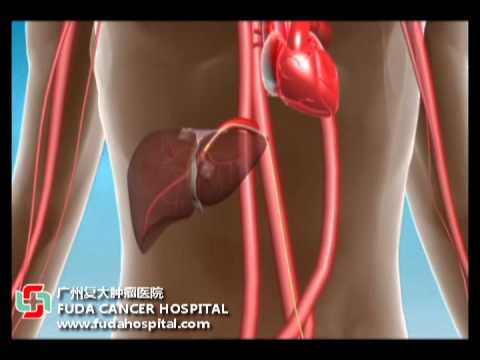 micro catheter - One or several types of chemotherapy drugs are embedded to nano particles or sealed in them using a special technology. Using an image-guided micro-catheter,...