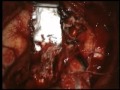 Application Of MPH In Glioblastoma. Application Of MPH In Glioblastoma.