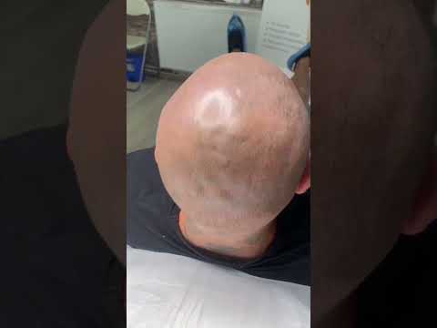 Micropigmentare Scalp 1 - 0