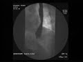 Esophageal X-ray - Barium Swallow