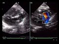 Echocardiography of Interrupted Aortic Arch Echocardiography of Interrupted Aortic Arch