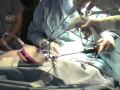 Introduction Method in Single Port / Single Incision Laparoscopy – GelPoint