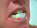 NTI fabrication using ThermoPlasticPutty