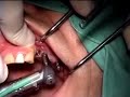 Implant failure 1.1
