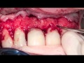 POSTGRADO CAPACITACION EN ENDODONCIA - CIRUGÍA APICAL