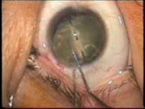 how to remove nylon stitches