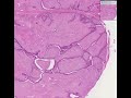 Histopathology Breast--Fibroadenoma Histopathology Breast--Fibroadenoma