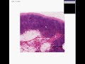 Histopathology Lymph node--Acute Lymphadenitis Histopathology Lymph node--Acute Lymphadenitis