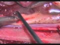 Laser-assisted microsurgical resection of thoracic intramedullary spinal cord ependymoma