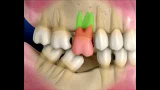 Implantes Dentários.