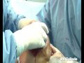 Protesis Total Rodilla.Dr E G Andujar & Dr E Galindo Martens