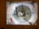 Step by Step Intralasik procedure for Monovision right eye of patient Sandy Step by Step Intralasik procedure for Monovision right eye of patient Sandy