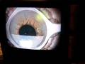 videos de Step by Step Intralasik procedure for Monovision right eye of patient Sandy
