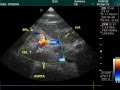 Celiac Trunk And Left Renal Vein In Doppler Examination Celiac Trunk And Left Renal Vein In Doppler Examination
