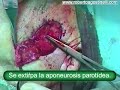 Epitelioma basocelular preauricular