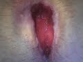 Pilonidal Excision 1 Month Post Op