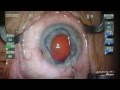 Oasis Pupil Expansion Ring