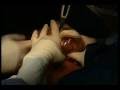 videos de Endoscopic views of breast, putting breast implant in