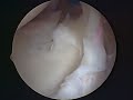 Torn Labrum Surgery