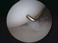 Torn Labrum Surgery