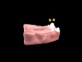 Overdenture simulation model - strain gauge placement - Dr. Mahmoud Ramadan