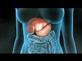 Cholecystectomie (galblaas verwijderen)