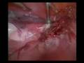 twisted fallopian tube