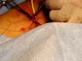 Cat�ter Swan-Ganz