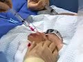 Catheter-Ablation-w-