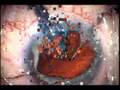 Advanced Traumatic Cataract extraction repair of the iris di