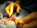 vasectomy part 2