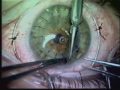 transplante de cornea