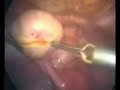 Paciente de 32 anos, sem filhos com massa complexa nos 2 ovários.Tratamento laparoscópico conservando os dois ovários.Dr Alexandre Silva e Silvadralexandresilva@hotmail.com