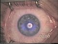 No LASIK, c-TEN (custom Trans-Epithelial No-touch)