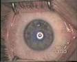 No LASIK, new prosedures with 1 000 Hz laser